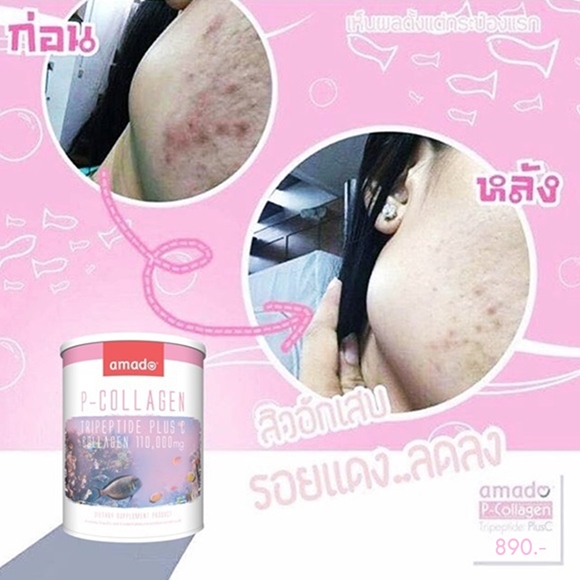 amado-collagen-ลดสิว